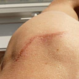 a scar on a person's back